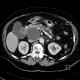 Pseudocyst of pancreas, compression of bile duct: CT - Computed tomography